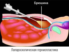 Единственный метод лечения бедренной грыжи - хирургическая операция