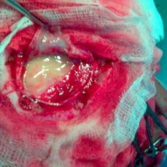 Гематогенный абсцесс головного мозга