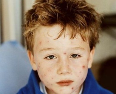 Ребенок болеющий ветрянкой