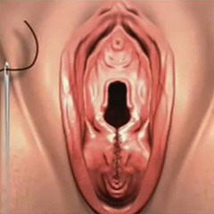 Гименопластика – операция по восстановлению девственной плевы