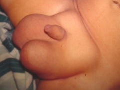 Паховая грыжа