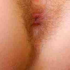 Зуд вокруг заднего прохода может свидетельствовать о наличии глистов