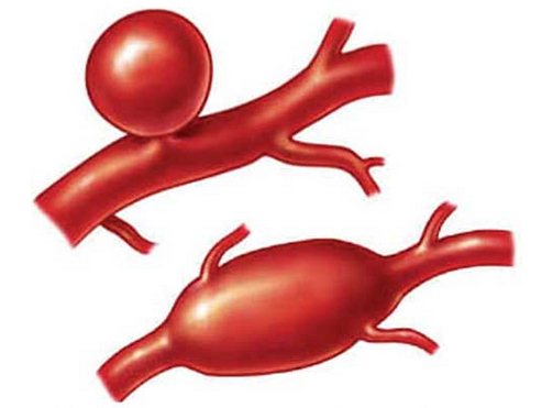 Аневризма сосудов головного мозга