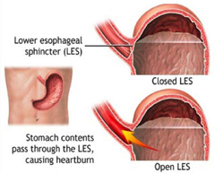 Причины изжоги