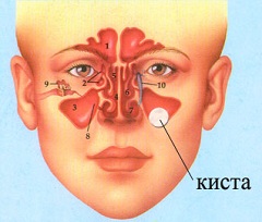 Истинная киста гайморовой пазухи