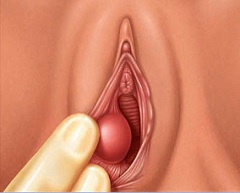 Одна из причин образования кист влагалища - родовая травма