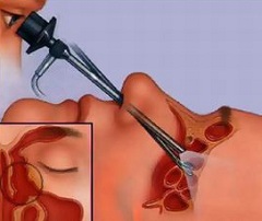 Единственный метод лечения кисты гайморовой пазухи - удаление
