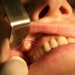 Киста зуба на его корне