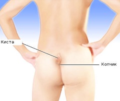 Киста копчика - отверстие в области ягодичной линии