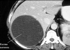 Киста печени на томографе