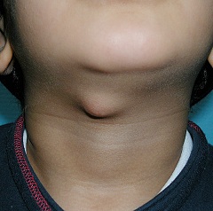 Киста шеи - полое образование, заполненное жидкостью