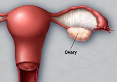 Киста яичника