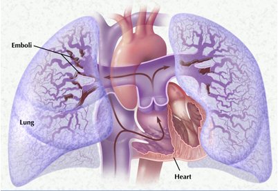 Легочная гипертензия