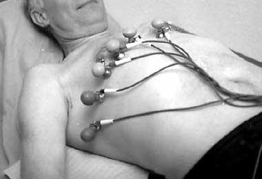 Лечение легочной гипертензии