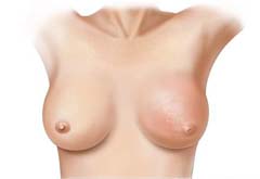 Симптомы мастита