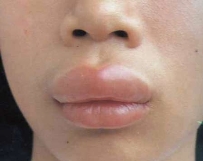 Отек Квинке на лице