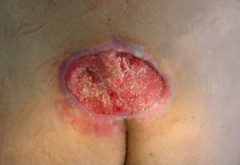 Стадии пролежней