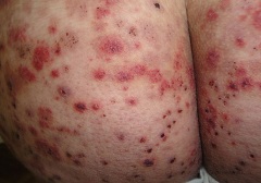 Начало пурпуры сосудистой - озноб и сыпь