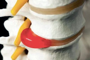 Лечение межпозвоночной грыжи диска Лечение межпозвоночной грыжи диска