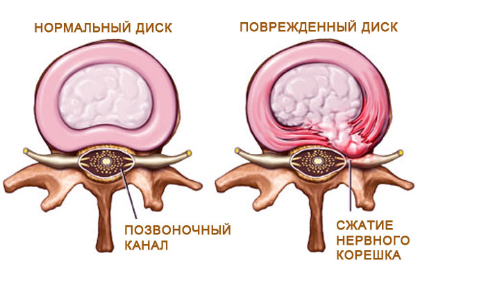 Межпозвоночная грыжа диска Межпозвоночная грыжа диска