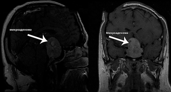 МРТ микроаденомы
