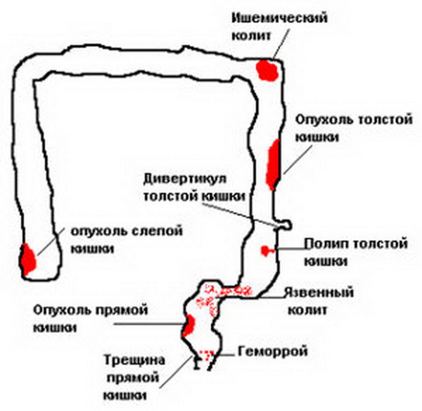 на фото кишечник с различными причинами кровотечений