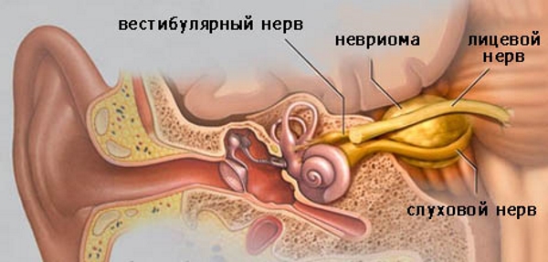 Невринома головного мозга
