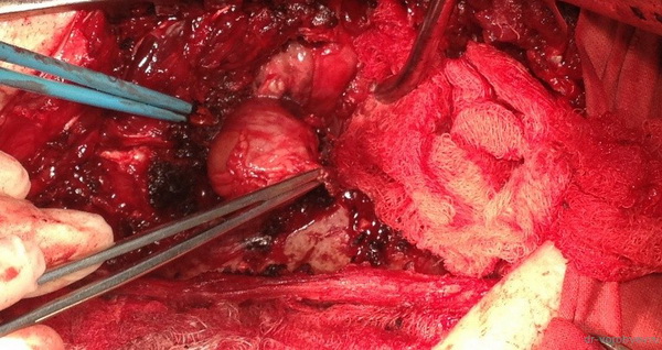 Удаление невриномы